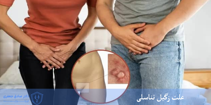 علت زگیل تناسلی