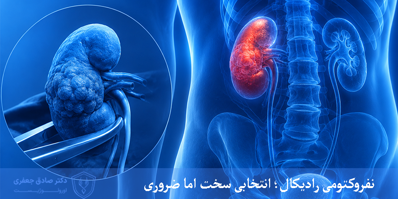 نفروکتومی رادیکال؛ انتخابی سخت اما ضروری