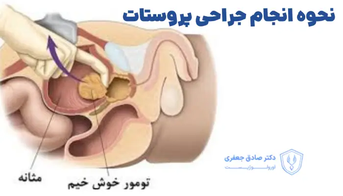 نحوه انجام جراحی پروستات