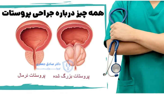همه چیز درباره جراحی پروستات