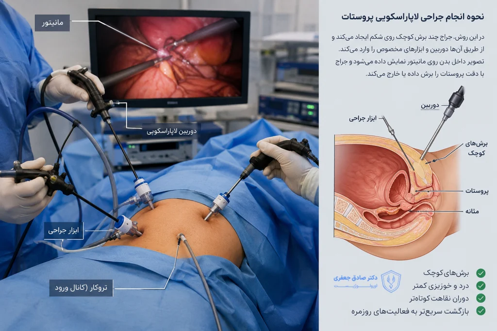 مراحل انجام لاپاراسکوپی پروستات
