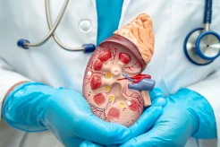 Radical Nephrectomy